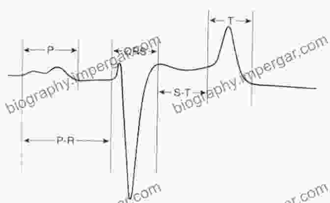 Electrocardiogram Tracing Of An Equine Arrhythmia Cardiology Of The Horse