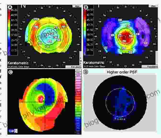 Illustration Depicting The Use Of Corneal Topography In Refractive Surgery Planning And Optimization Corneal Topography: Principles And Applications