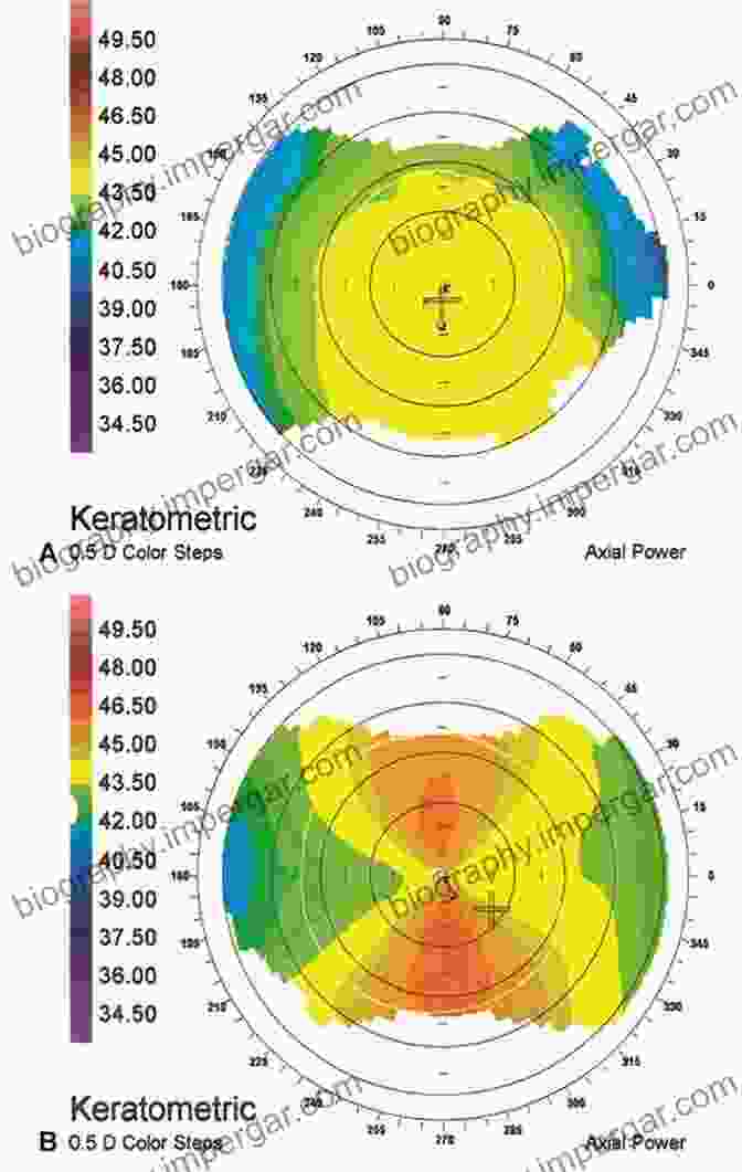 Illustration Showcasing The Characteristic Corneal Topography Patterns In Different Corneal Diseases Corneal Topography: Principles And Applications