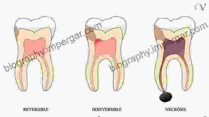 Microscopic Image Showcasing Various Stages Of Pulpal Inflammation, Including Reversible Pulpitis And Irreversible Pulpitis The Principles Of Endodontics