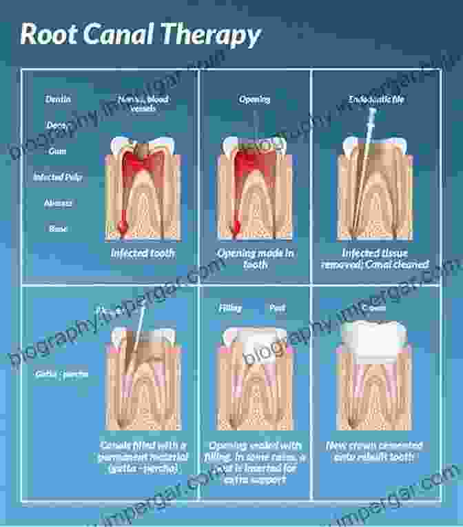 Step By Step Depiction Of Root Canal Treatment, From Access Cavity Preparation To Obturation The Principles Of Endodontics