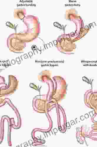 Complications In Bariatric Surgery Gerhart Niemeyer