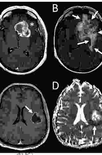 Imaging Gliomas After Treatment: A Case Based Atlas