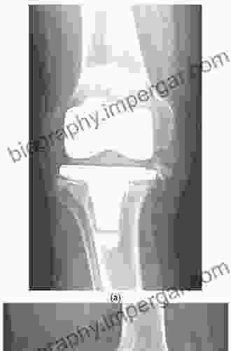 Periprosthetic Joint Infection Of The Hip And Knee